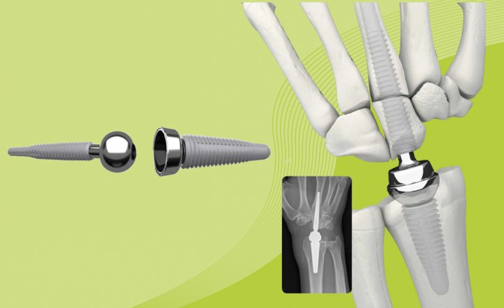 MOTEC – wrist endoprosthesis – new to MED&CARE’s portfolio